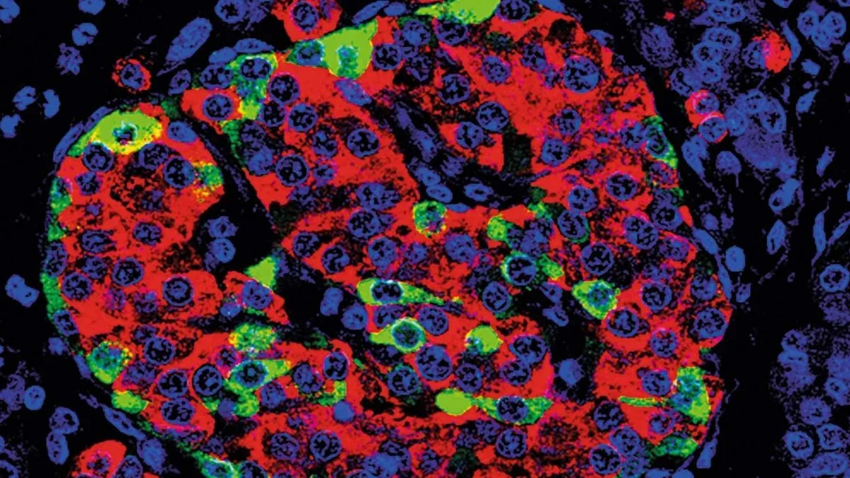 Groundbreaking Stem Cell Therapy Shows Promise in Reversing Type 1 Diabetes
